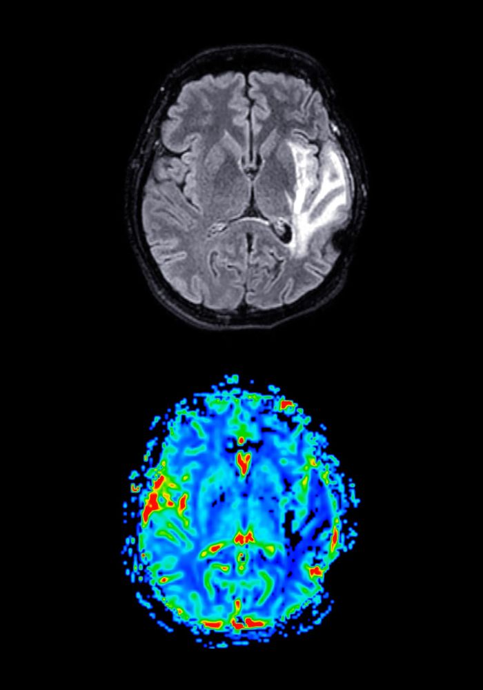 Two images showing the activity of the brain during a football fan. Image credit: Radiological Society of North America